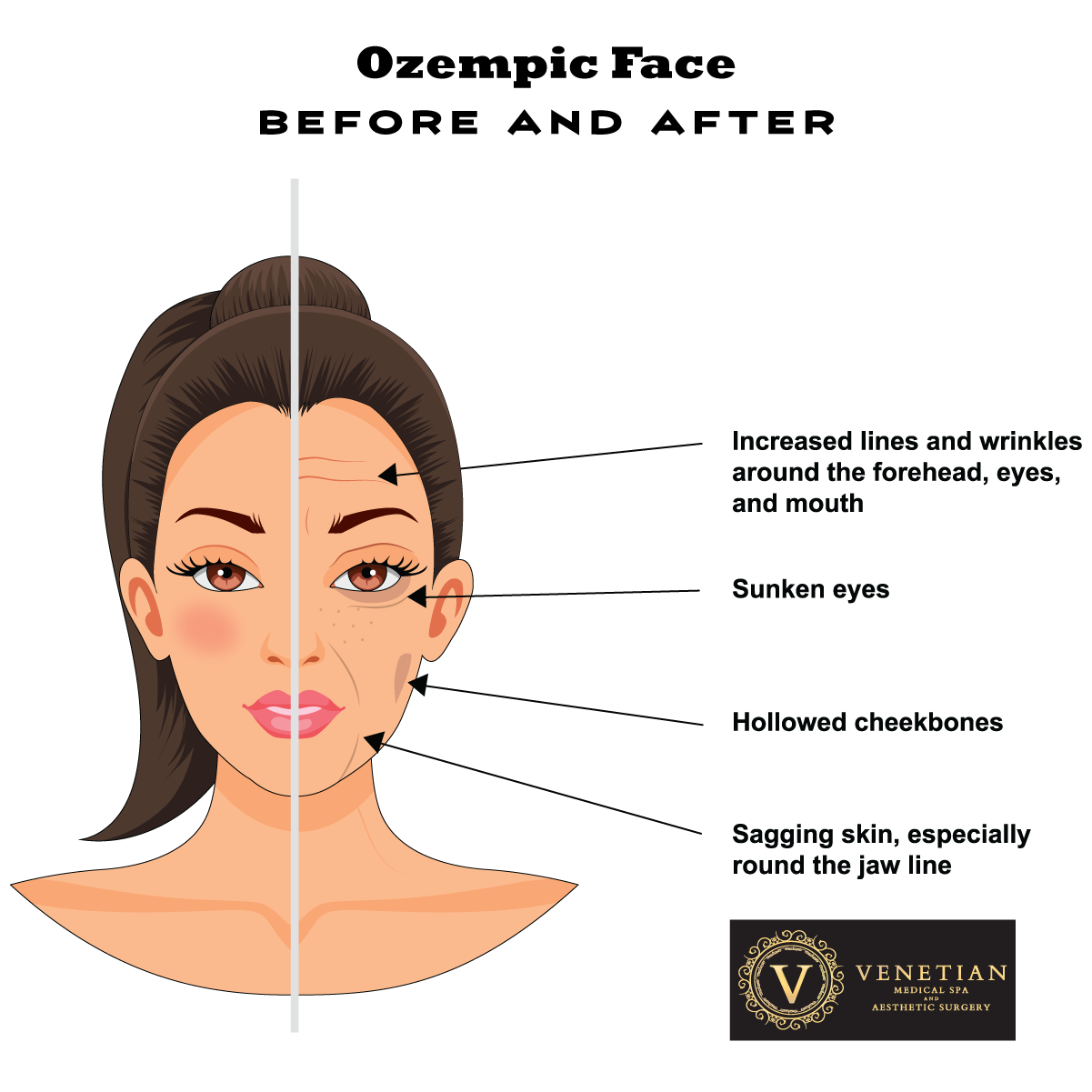 ozempic face before and after